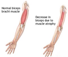 Атрофия мышц один из симптомов бокового амиотрофического склероза